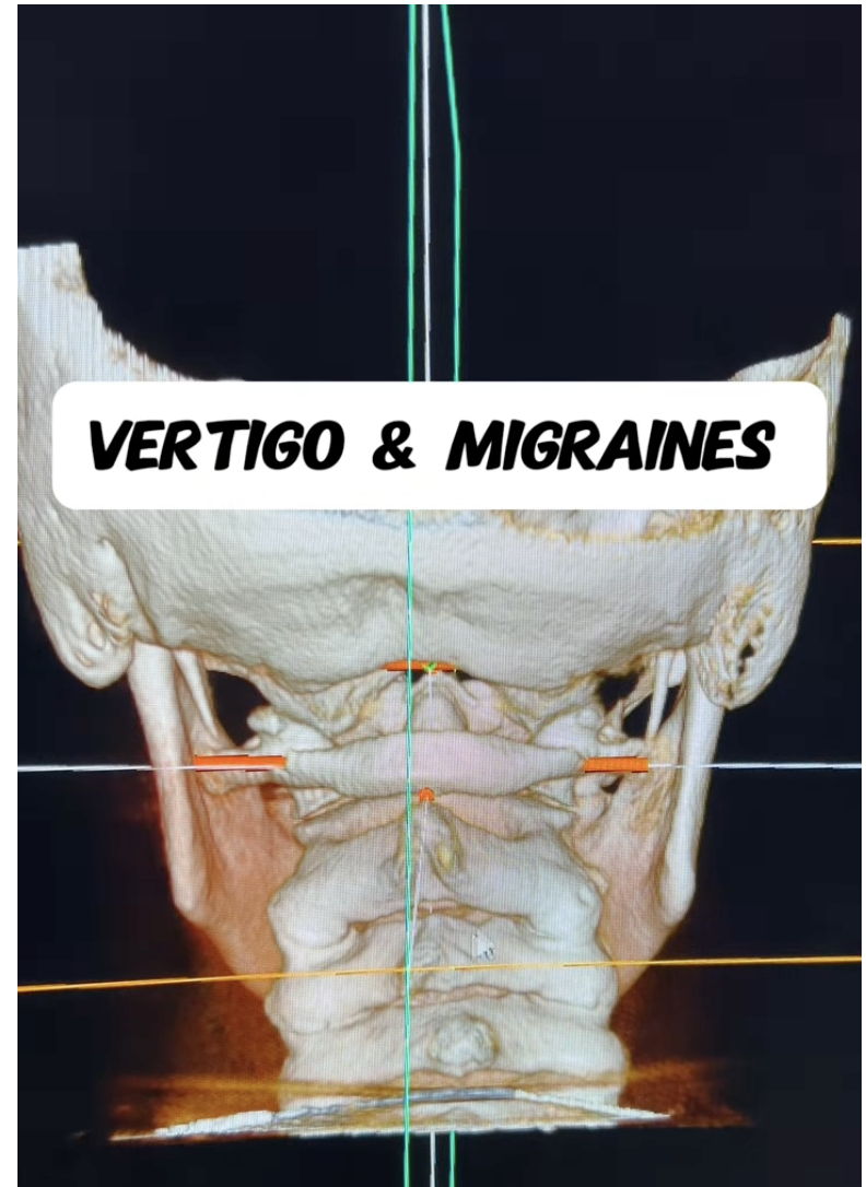 Vertigo and Migraines Sarasota Florida