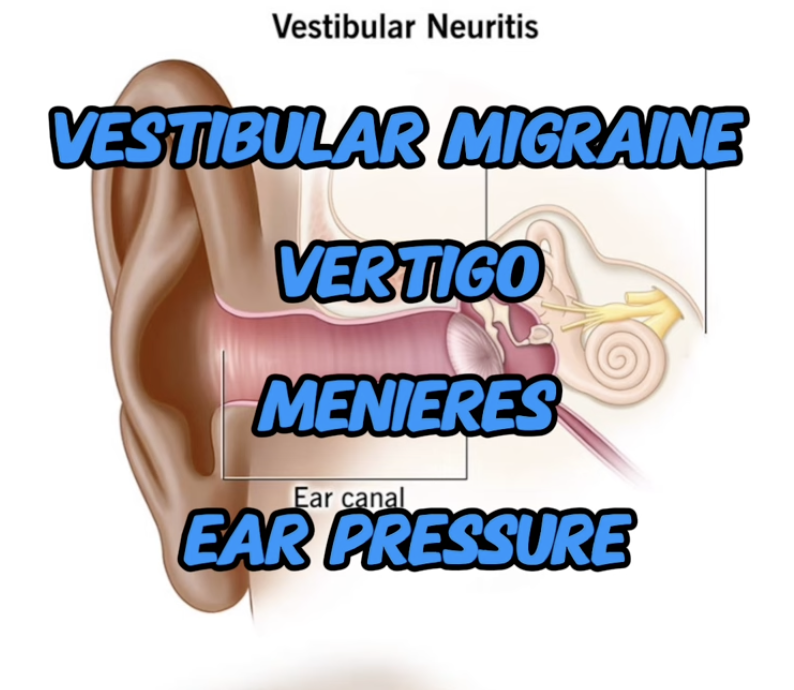 Menderes vestibular neuritis and vertigo sarasota