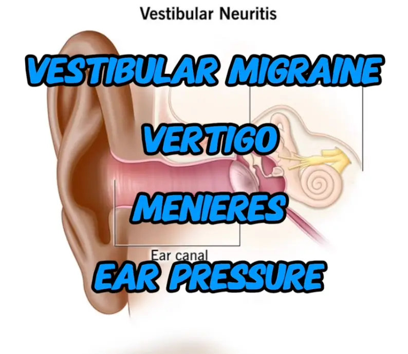 Menderes vestibular neuritis and vertigo sarasota