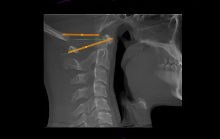 Upper Cervical Alignment