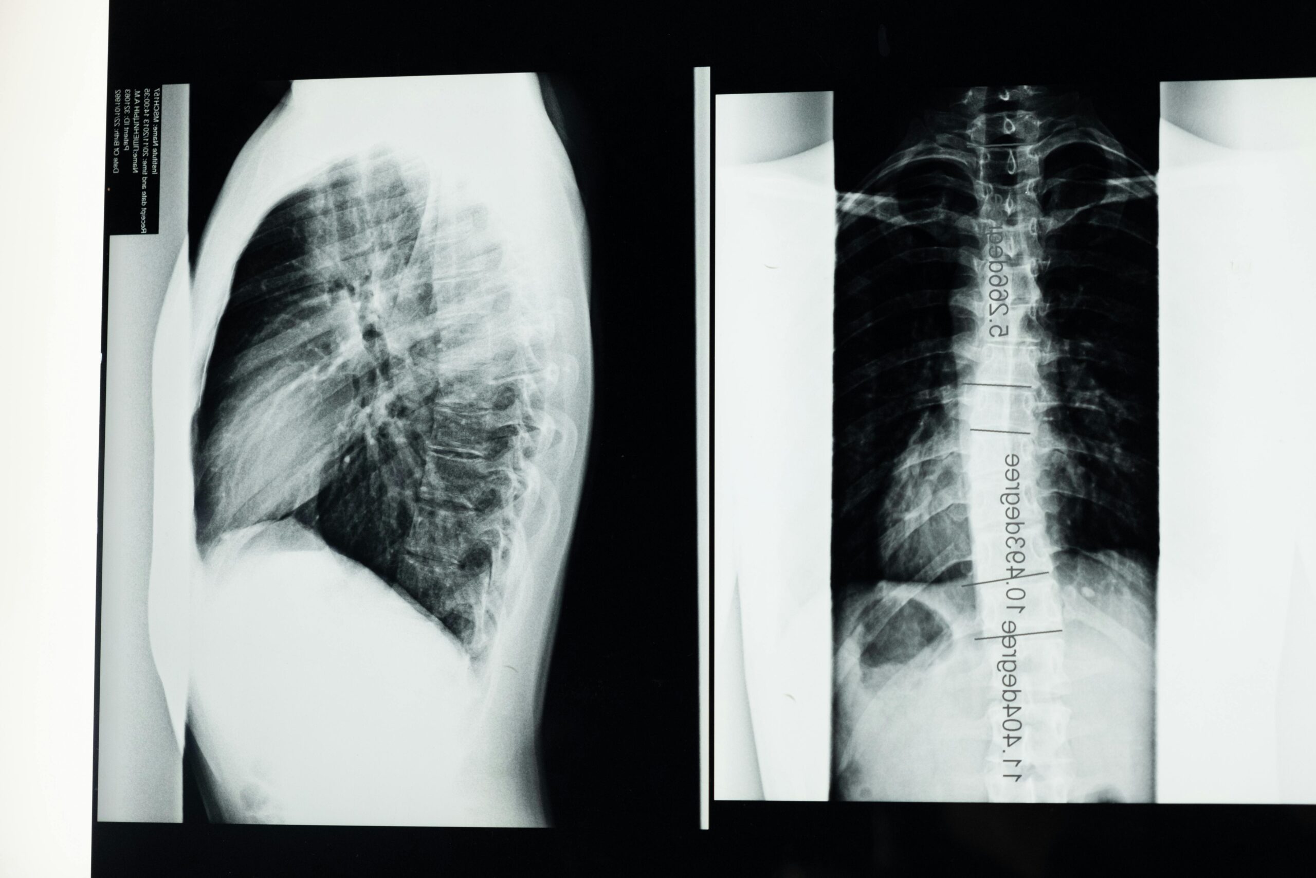 Best Scoliosis Doctor Sarasota