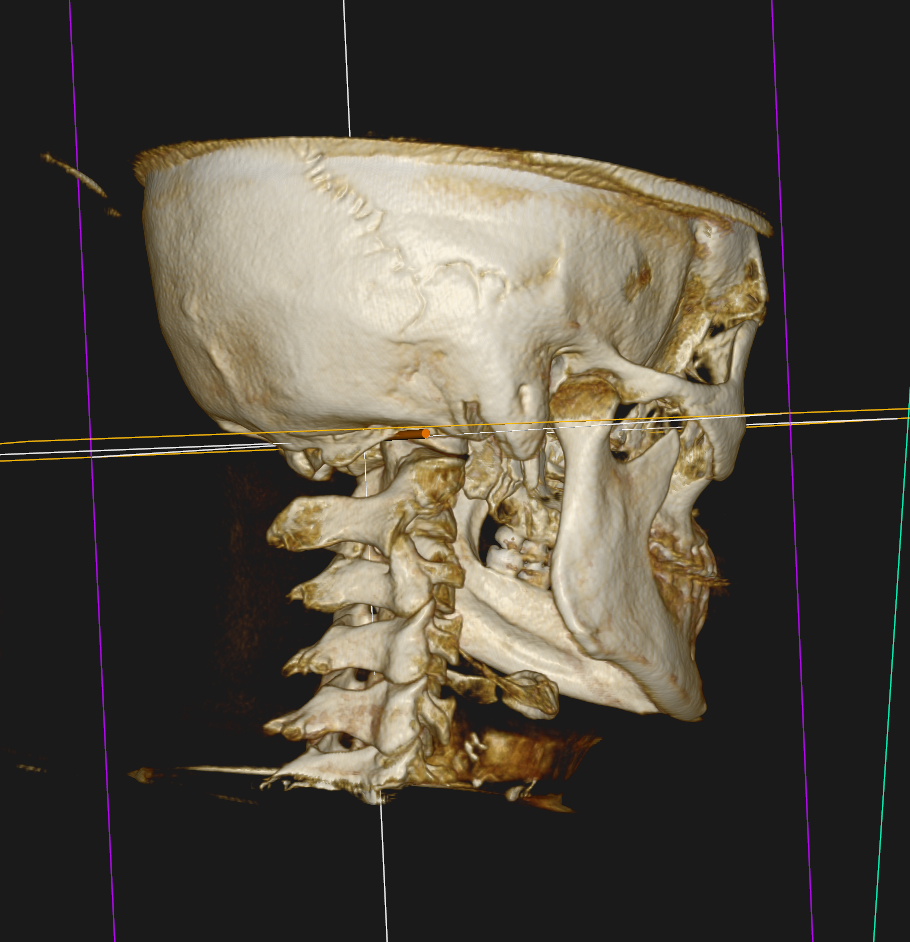 Imaging for migraines