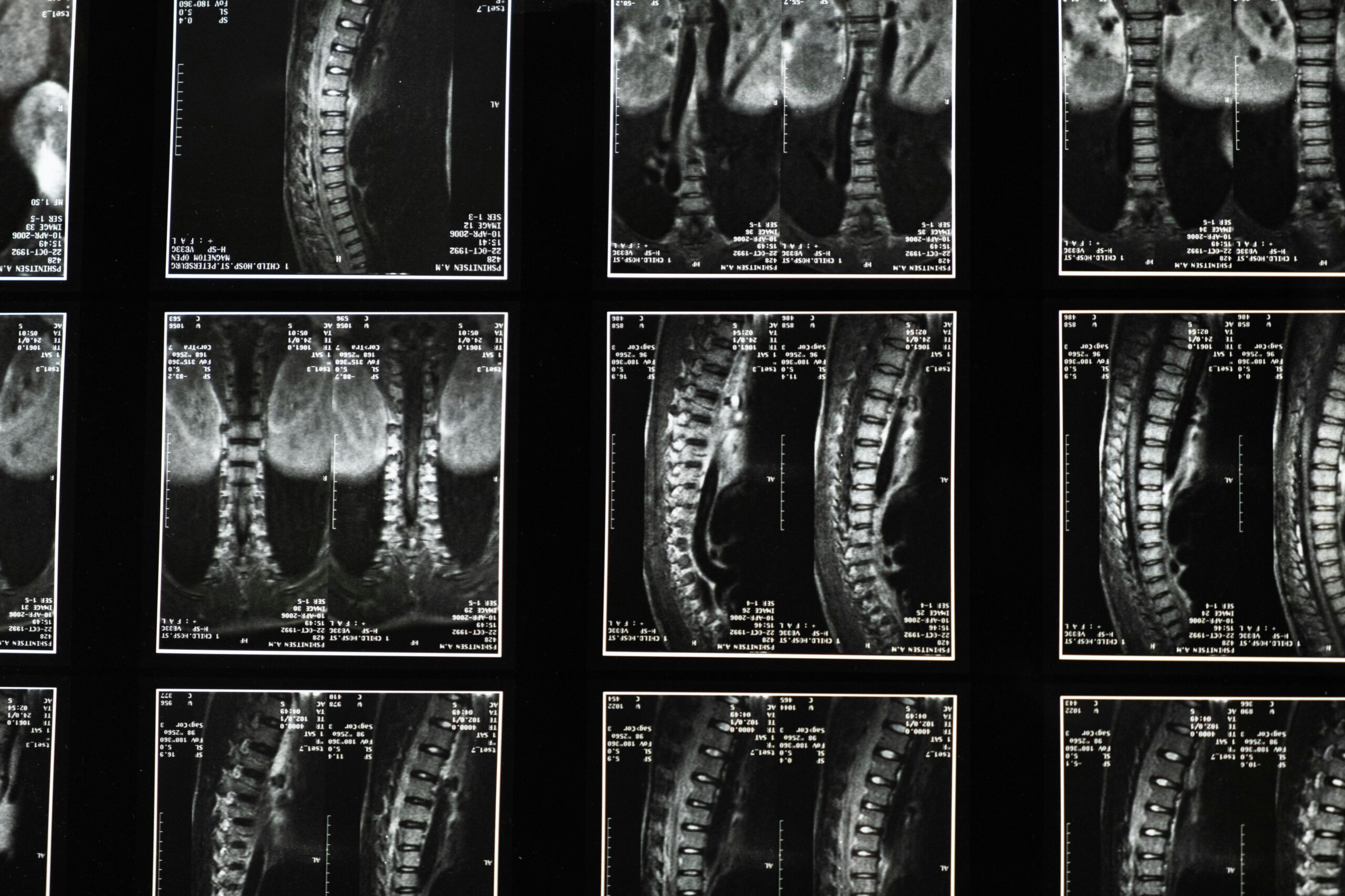 Scoliosis Doctor Near Me: How Upper Cervical Chiropractic at Lavender Family Chiropractic Helps Realign Posture, Ease Pain, and Support a Healthier Spine