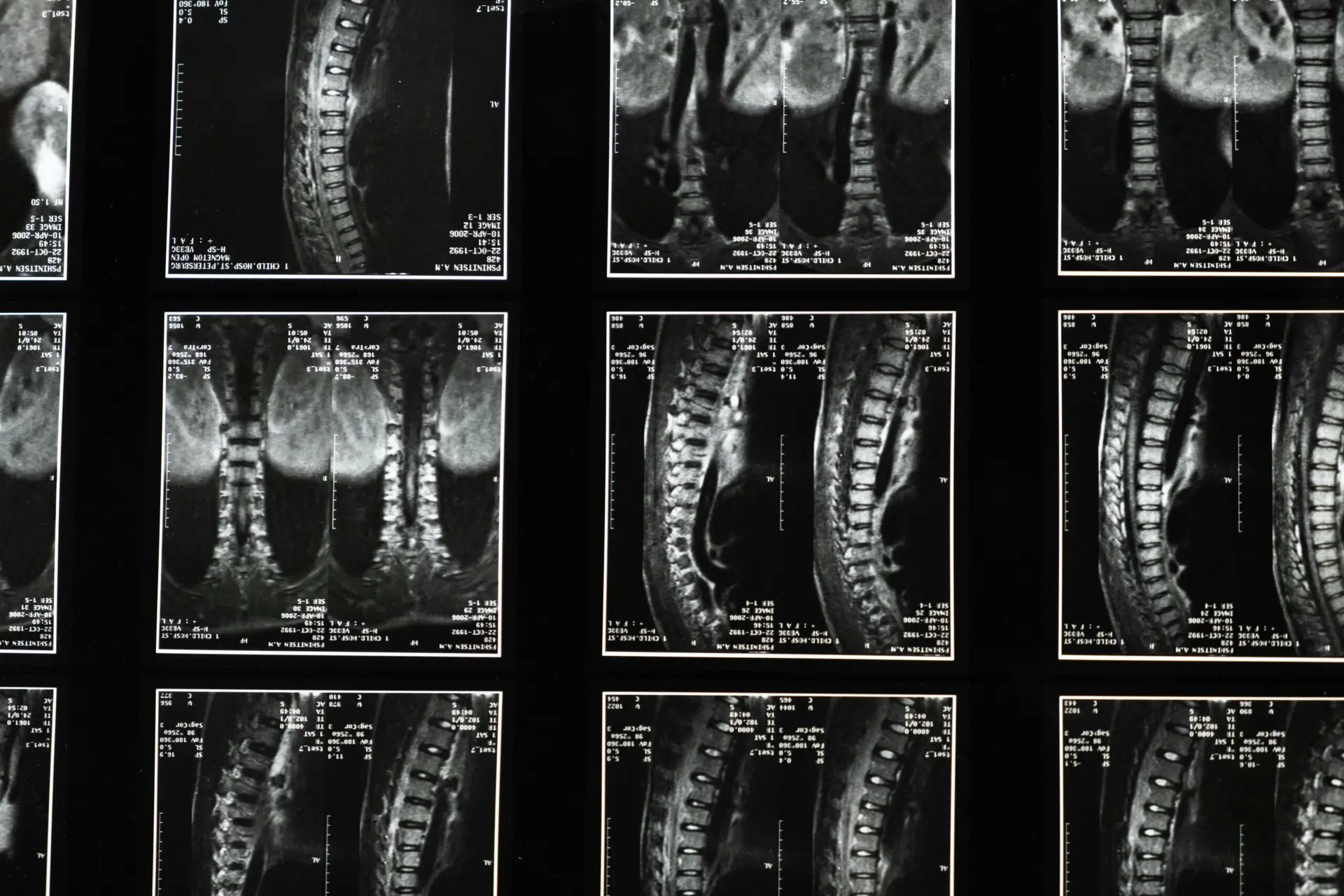 Scoliosis Doctor Near Me