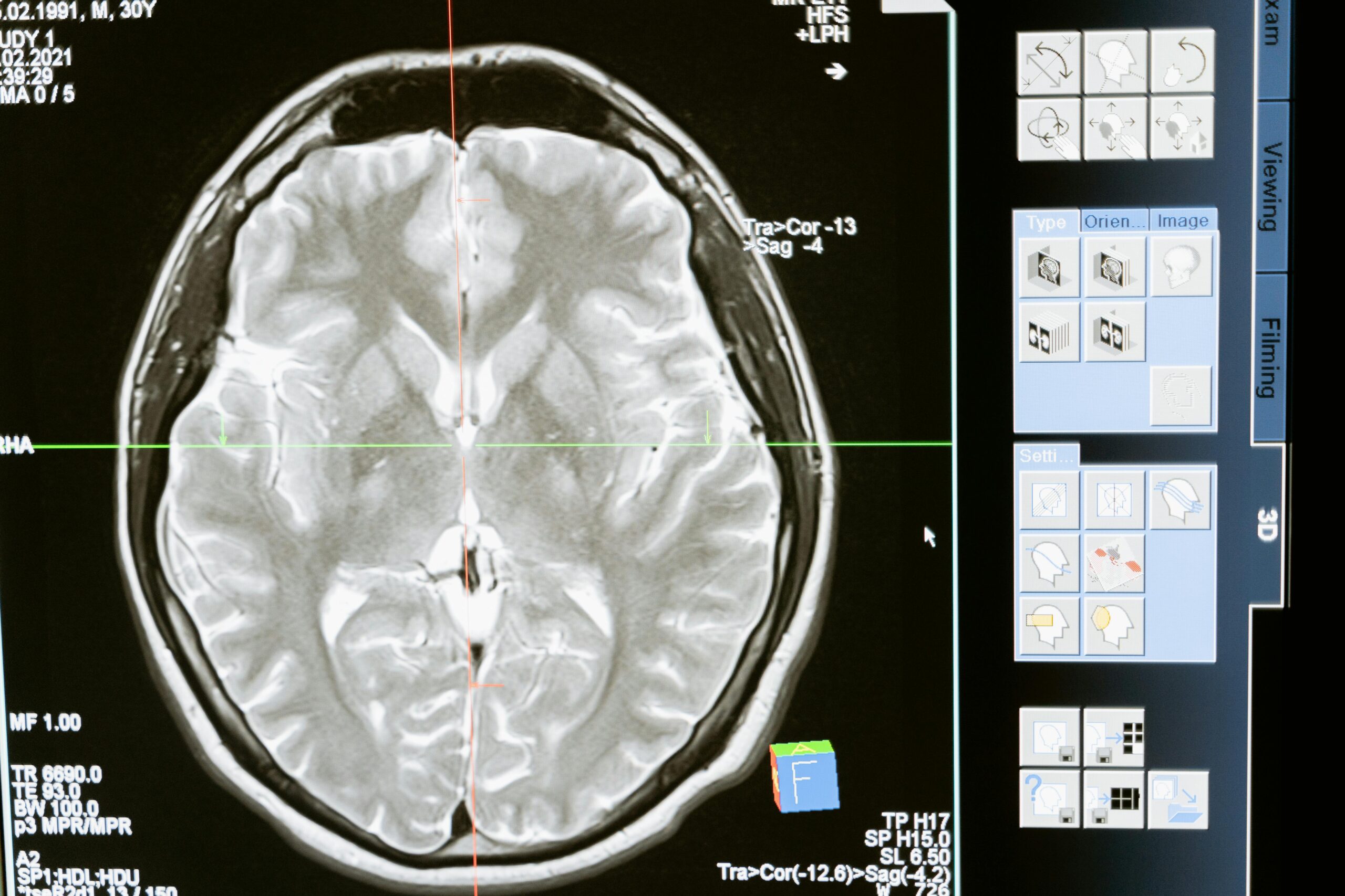 Brain Fog and Cerebrospinal Fluid: The Overlooked Connection—and How Upper Cervical Chiropractic Restores Clarity