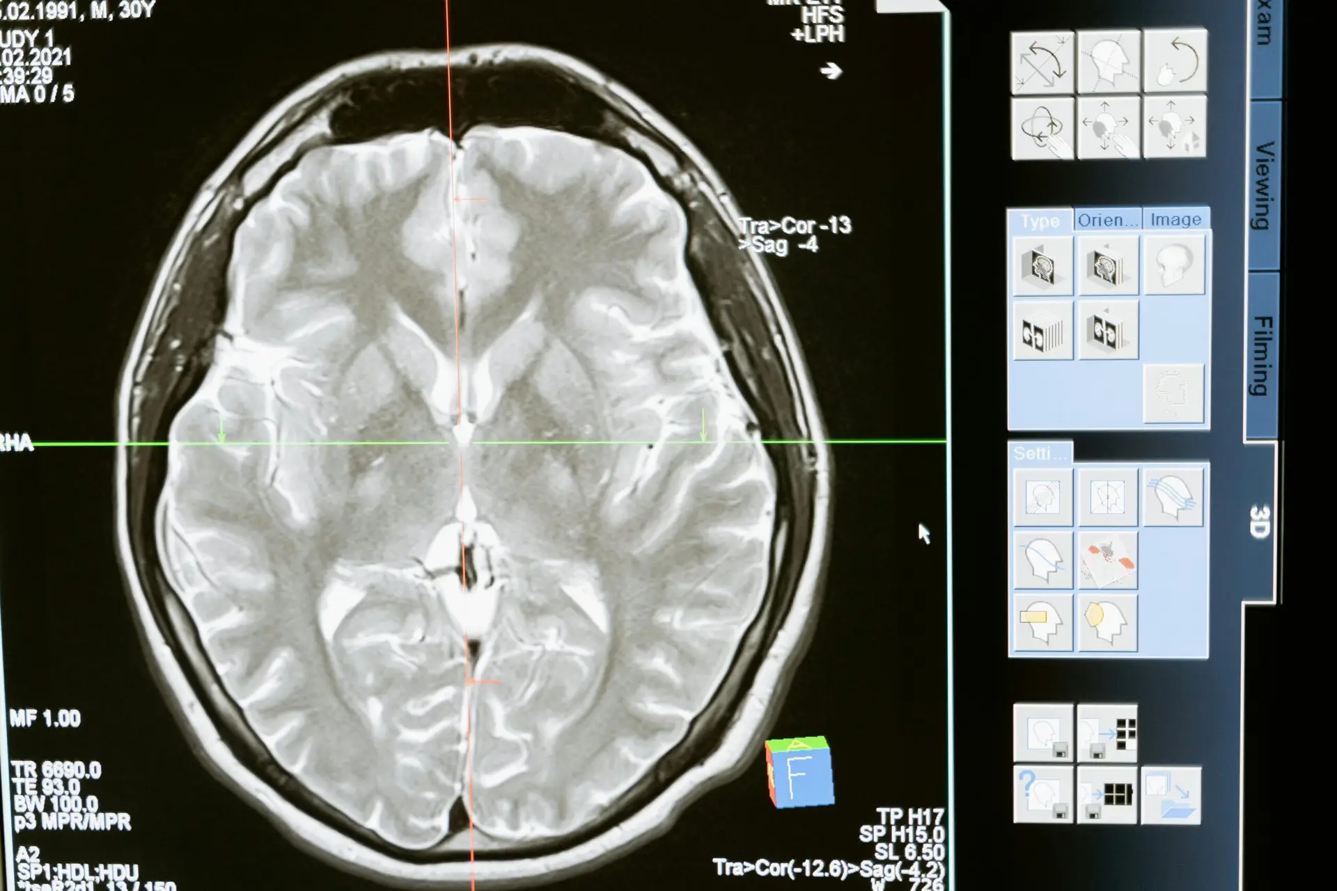 Cerebrospinal Fluid